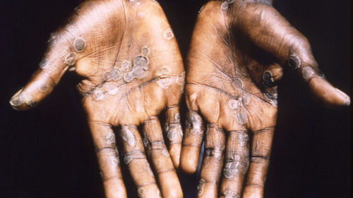 Latest company news about El brote de Monkeypox plantea ‘riesgo moderado’ a la salud pública global, el WHO dice